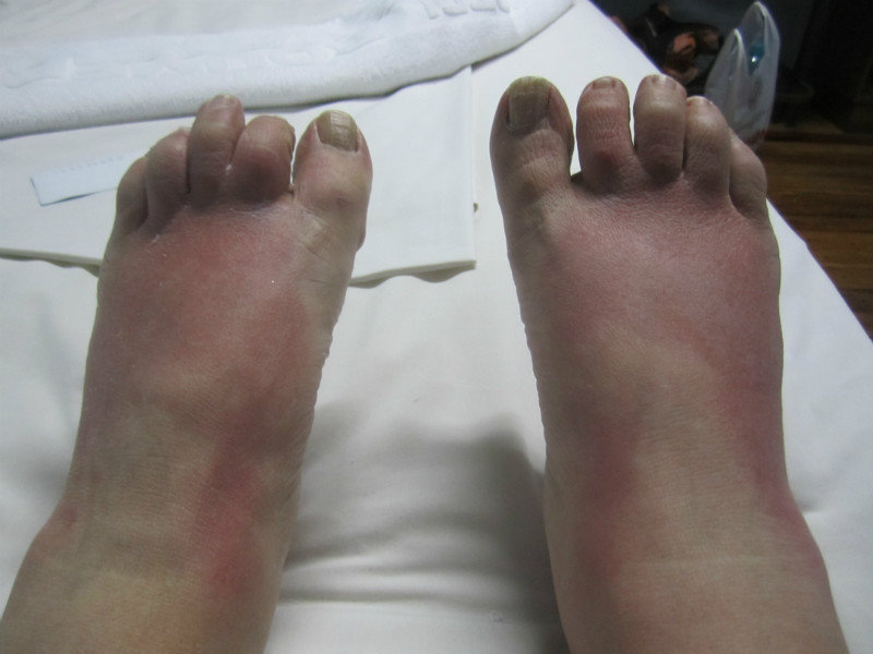 Oh dear sunburnt swollen feet!