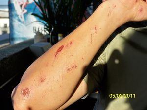 Dario´s scars from the bike