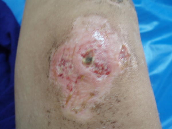 Here was the state of Louise's knee at this stage