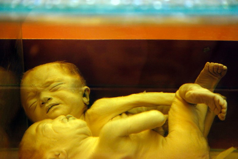 Preserved cojoined babies