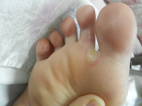 Healing foot