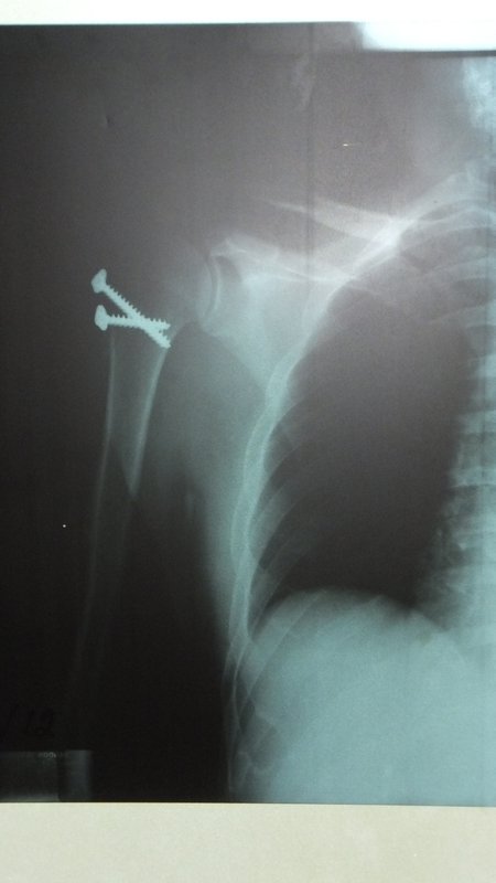 The fracture repair