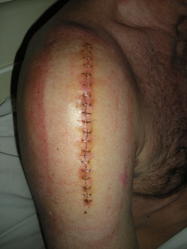 Paul's scar