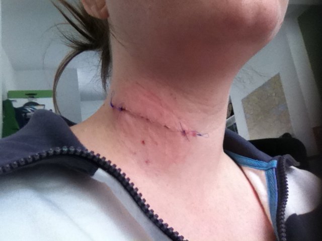 a week on - juicy stitches but impressive healing