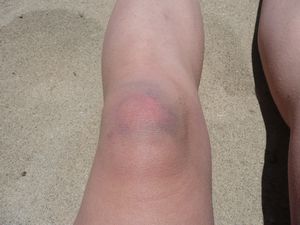 Check out my multi-coloured knee. Wah!