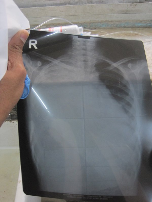 Patient's Chest X-Ray demonstrates an empyema
