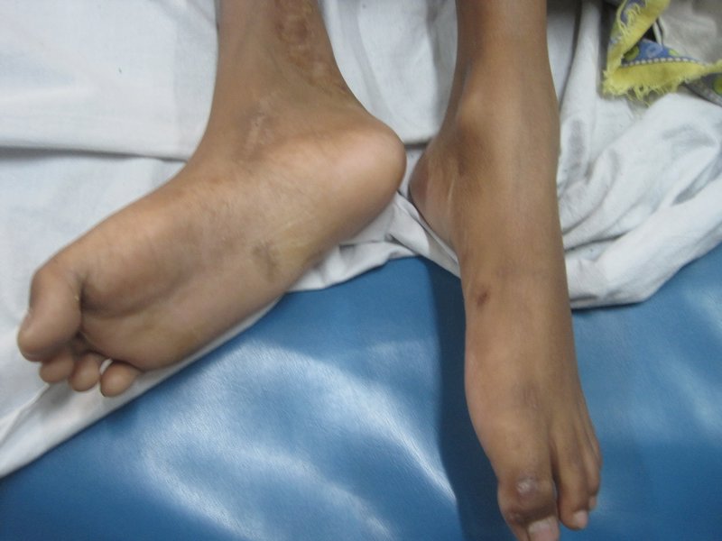 Bilateral foot drop from Guillan Barre Syndrome