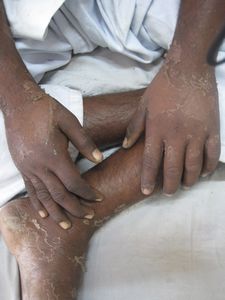 Patient recovering from Leprosy