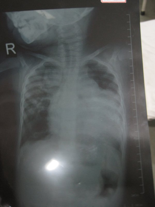 TAPVR on chest x-ray