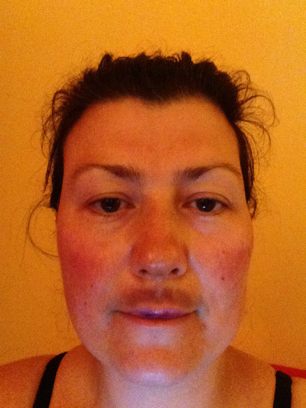 24 hrs later swelling reduced but bruising giving lovely mustache effect 