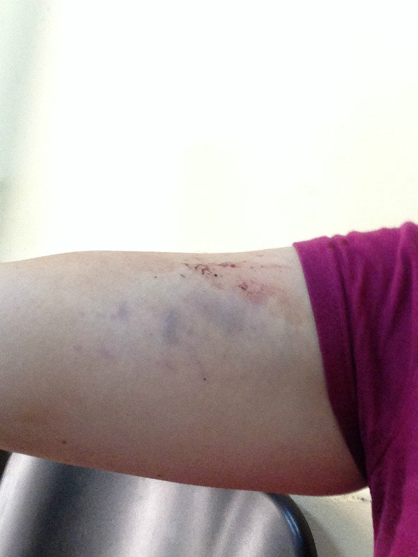 right upper arm bruises