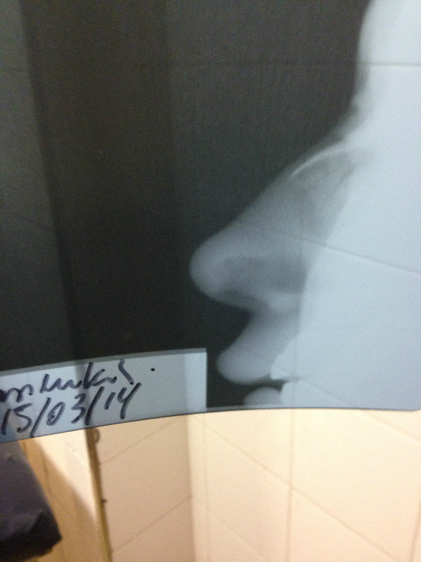 x ray of nose....there is no fracture