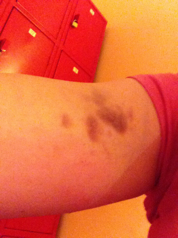 bruises 24 hrs later