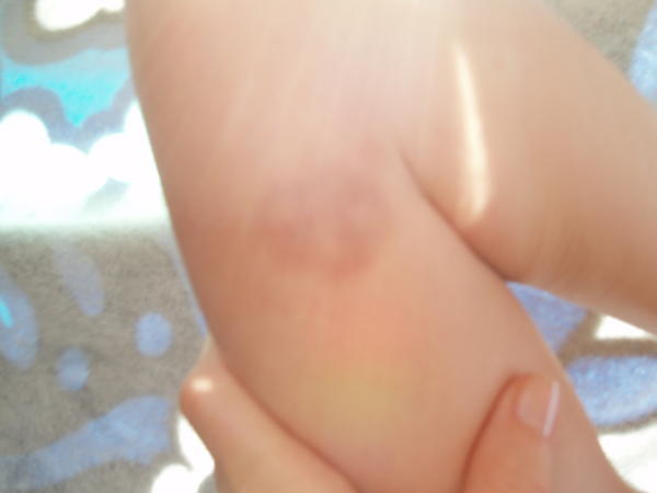 Lauries Bruise