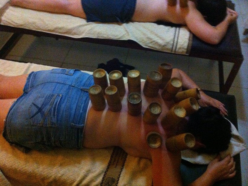 Hot cupping
