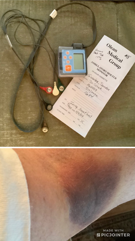 My Holter Monitor and horrible hematoma