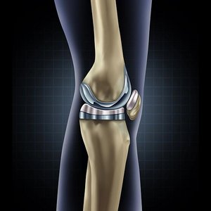 Total knee replacement 