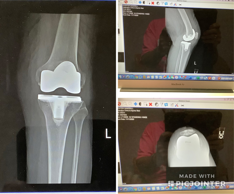 X-ray of my knee and new device