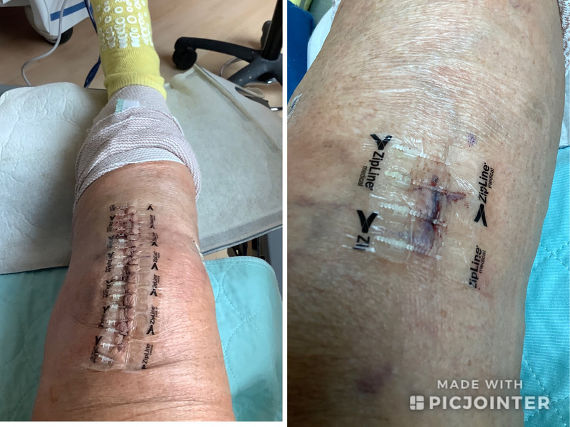 Knee and cyst incisions
