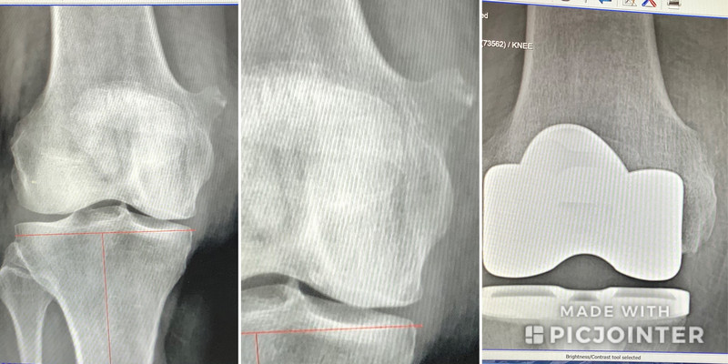 Bone spur (top right)....3rd photo: gone! 
