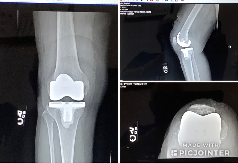 X-rays of my right knee replacement 