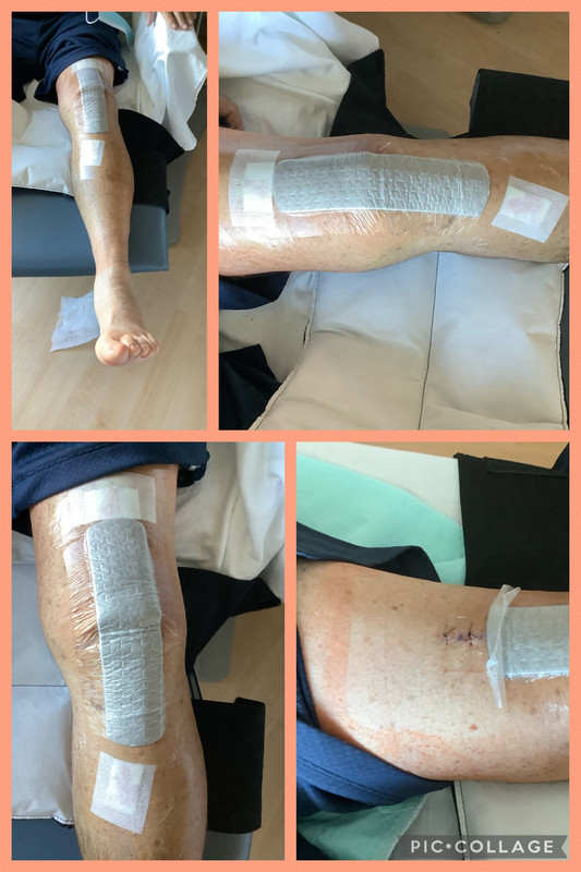 Cory’s knee and dressings 