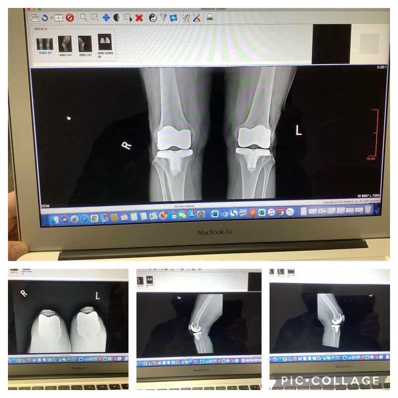 X-rays of Sandy’s year old knee replacements 