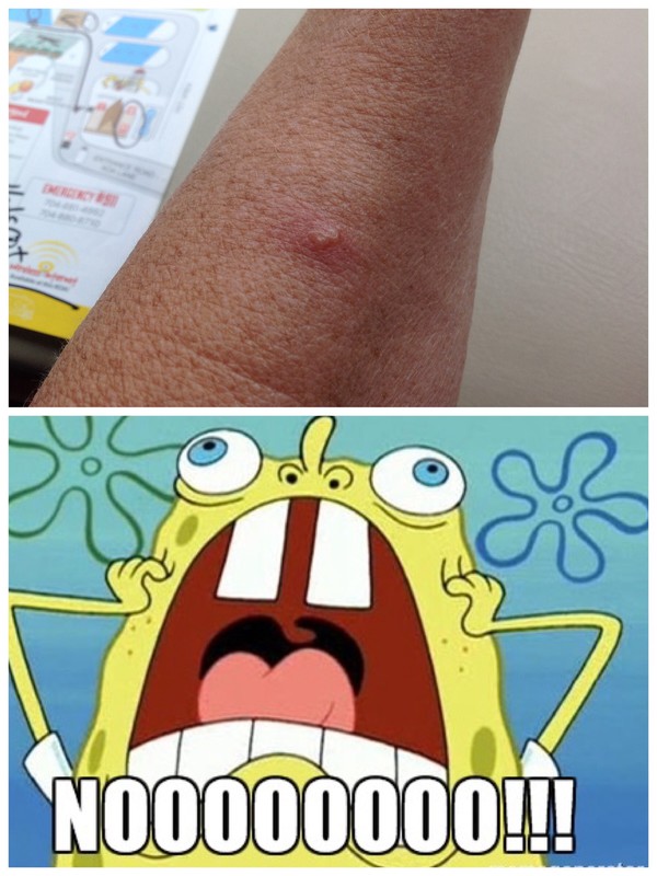 My bug bite! 