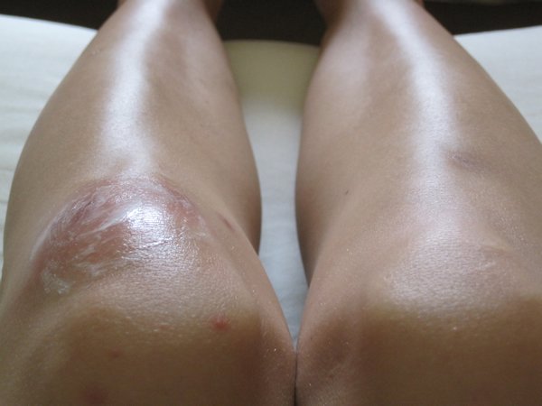 Eugh, my painful, swollen knee!