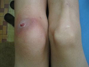 Big fat swollen knee first morning on Tioman