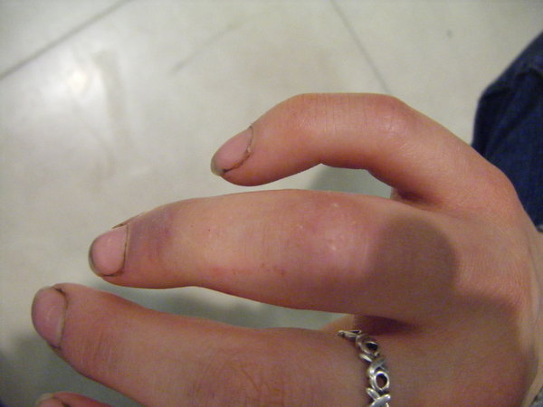 Broken finger =(