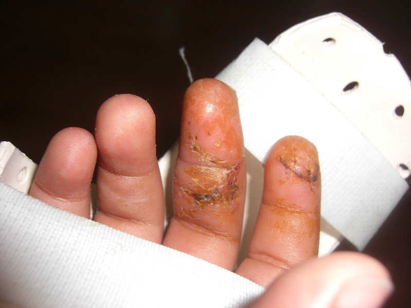 Still-Swollen Fingers