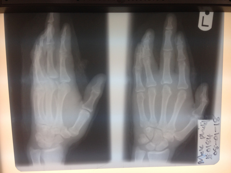 Hand fracture as the result of a chop chop