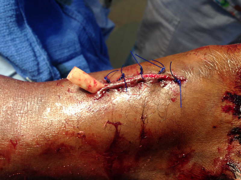 Repair of a dorsal foot laceration 