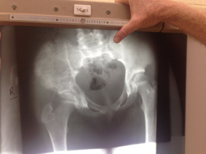 Osteomyelitis of the ischium of the hip
