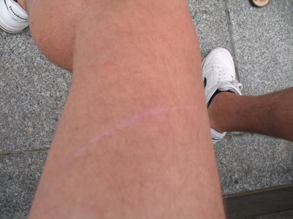 Graham's scar leg