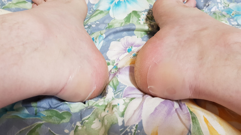 Bandaged Feet