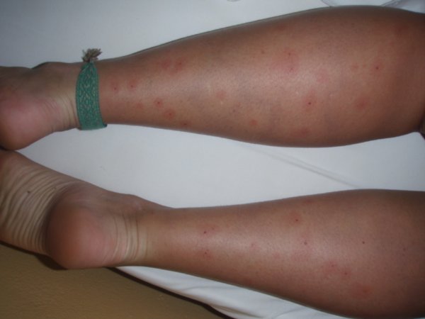 Amanda's legs after being eaten alive by bugs at Machupichu