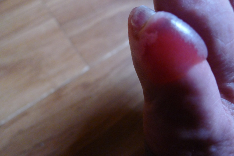 Small toe blister! 