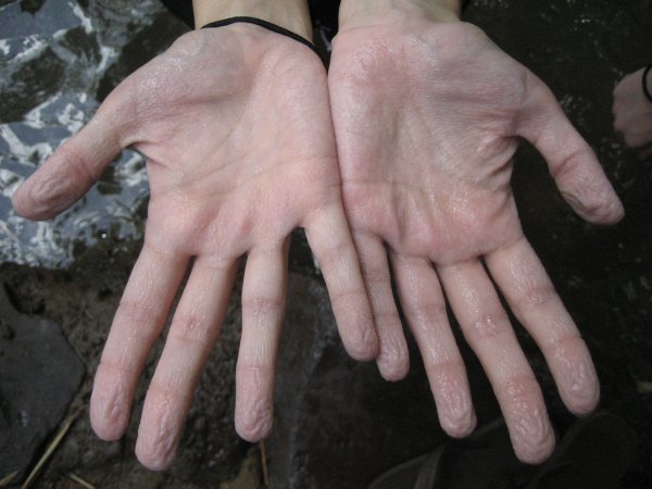 Bianca's hands after being in the water a tad too long..