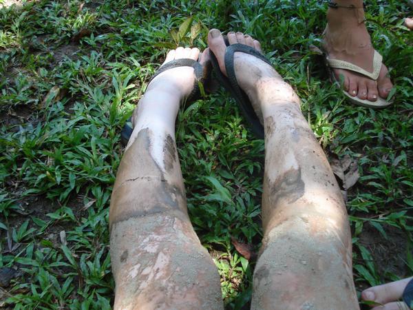 My legs after Sandoval, post welly removal