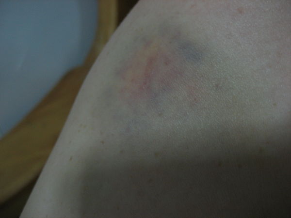 My Bruise!