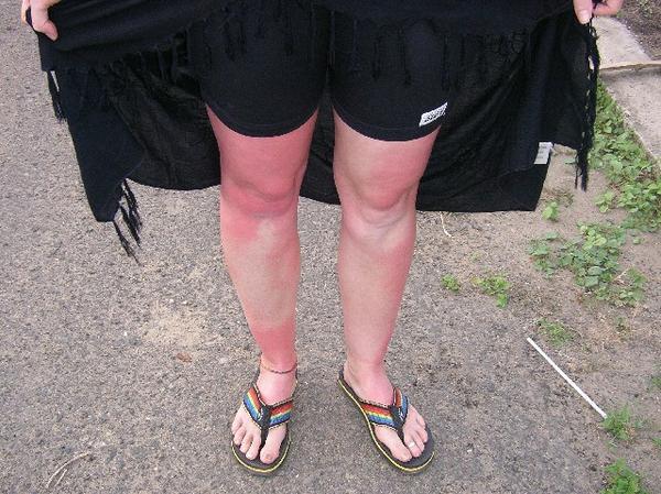 Kerensa's sunburned legs 