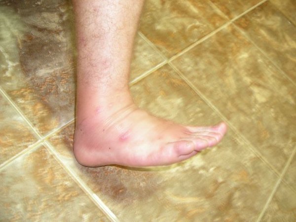 adams swollen and infected foot!