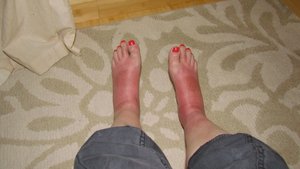Sunburned swollen feet