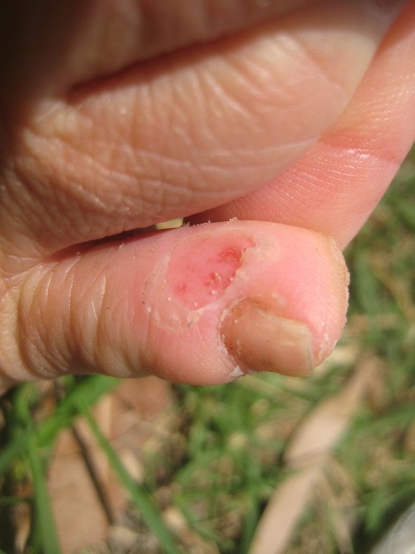 blister forming