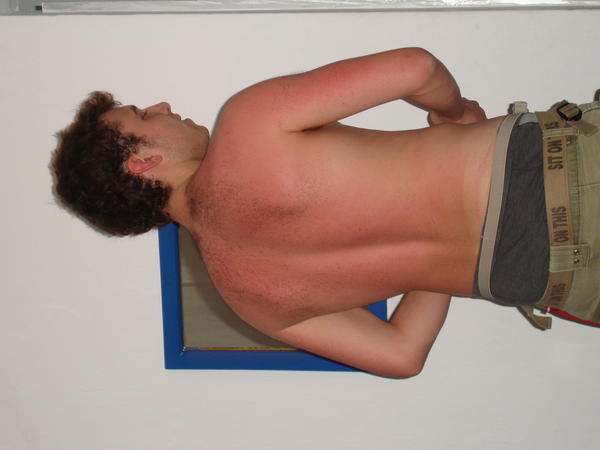 jacks sunburn