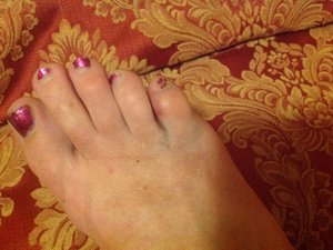 Swollen bruised little toe