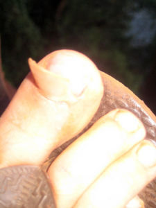 What happened to my toenail when I flipped at Super Hole...