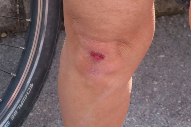 Jody Injures Her Knee